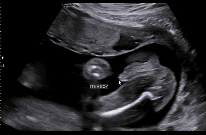 Baby Scans Gender