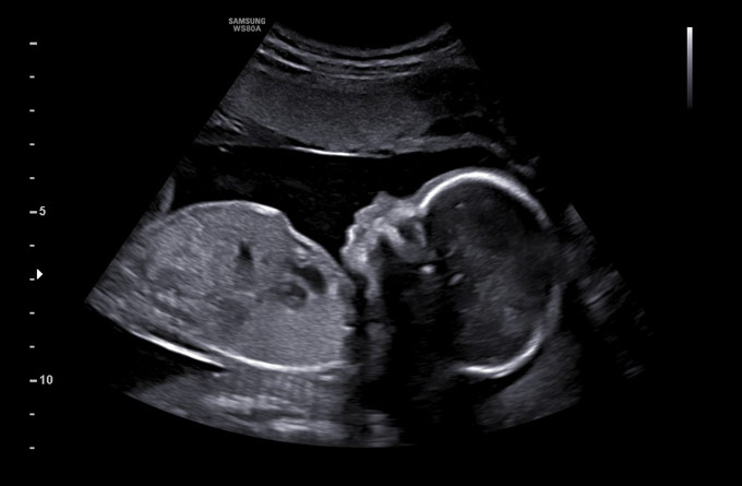 Baby Scans Presentation